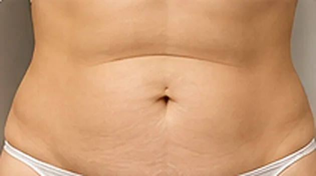 Abdomen antes del tratamiento de radiofrecuencia corporal
