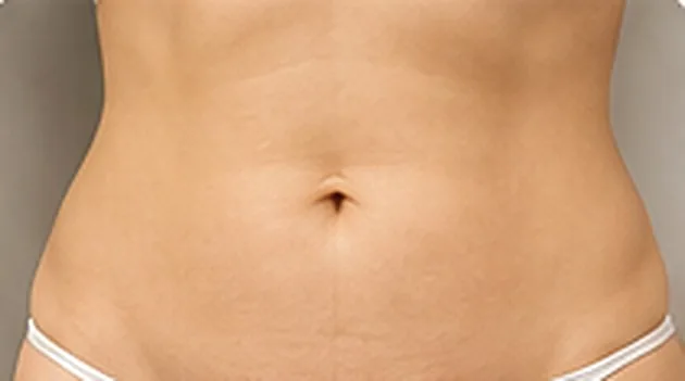 Abdomen después del tratamiento de radiofrecuencia corporal