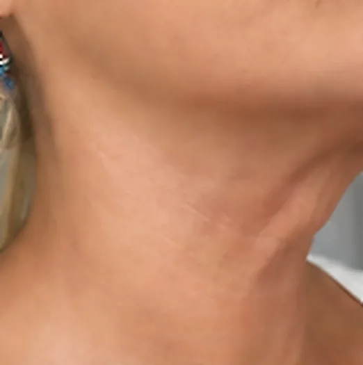 Cuello de perfil después del tratamiento de HIFU facial