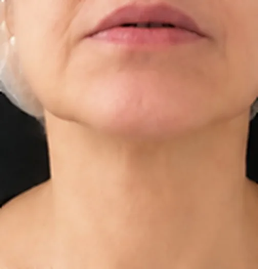 Cuello y papada después del tratamiento de HIFU facial