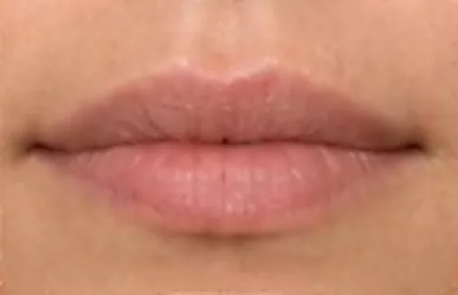 Labios antes del relleno con ácido hialurónico