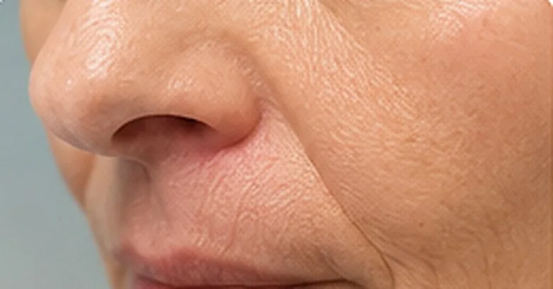 Surco nasogeniano antes del tratamiento de radiofrecuencia facial