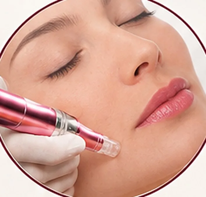 Aplicación de dermapen en la mejilla de una paciente